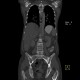 Multiple myeloma, venooclusive disease of liver, hypervascular nodules: CT - Computed tomography